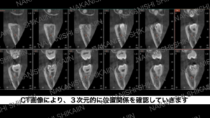 CT画像により３次元的に位置関係を確認していきます